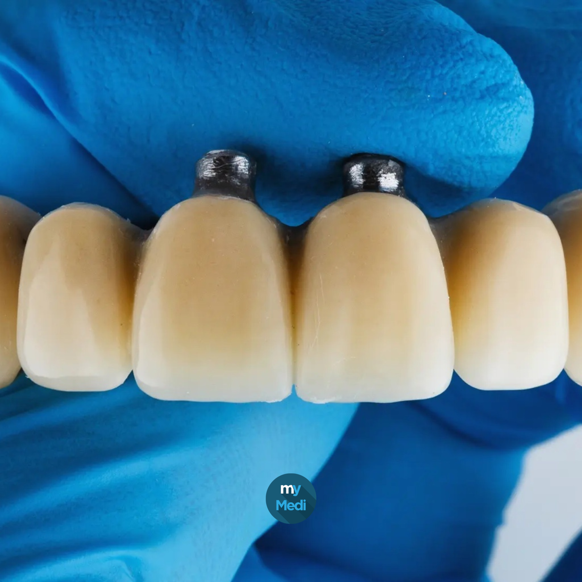 Composants prothétiques