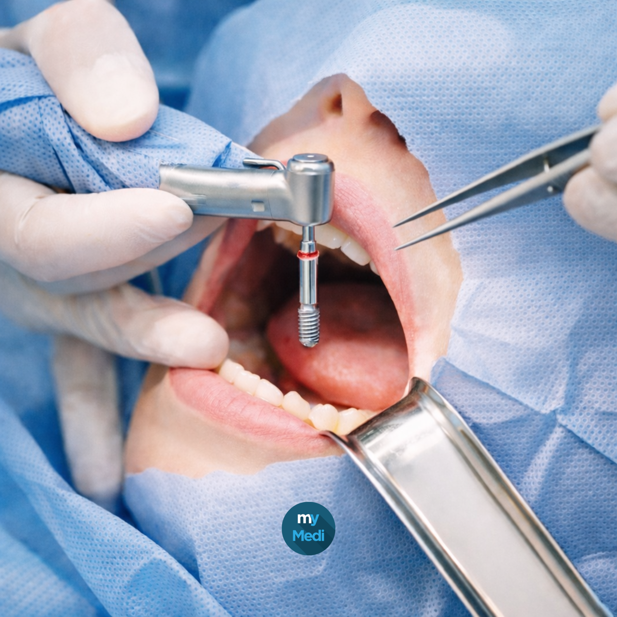 Endodontie Chirurgie et Implants