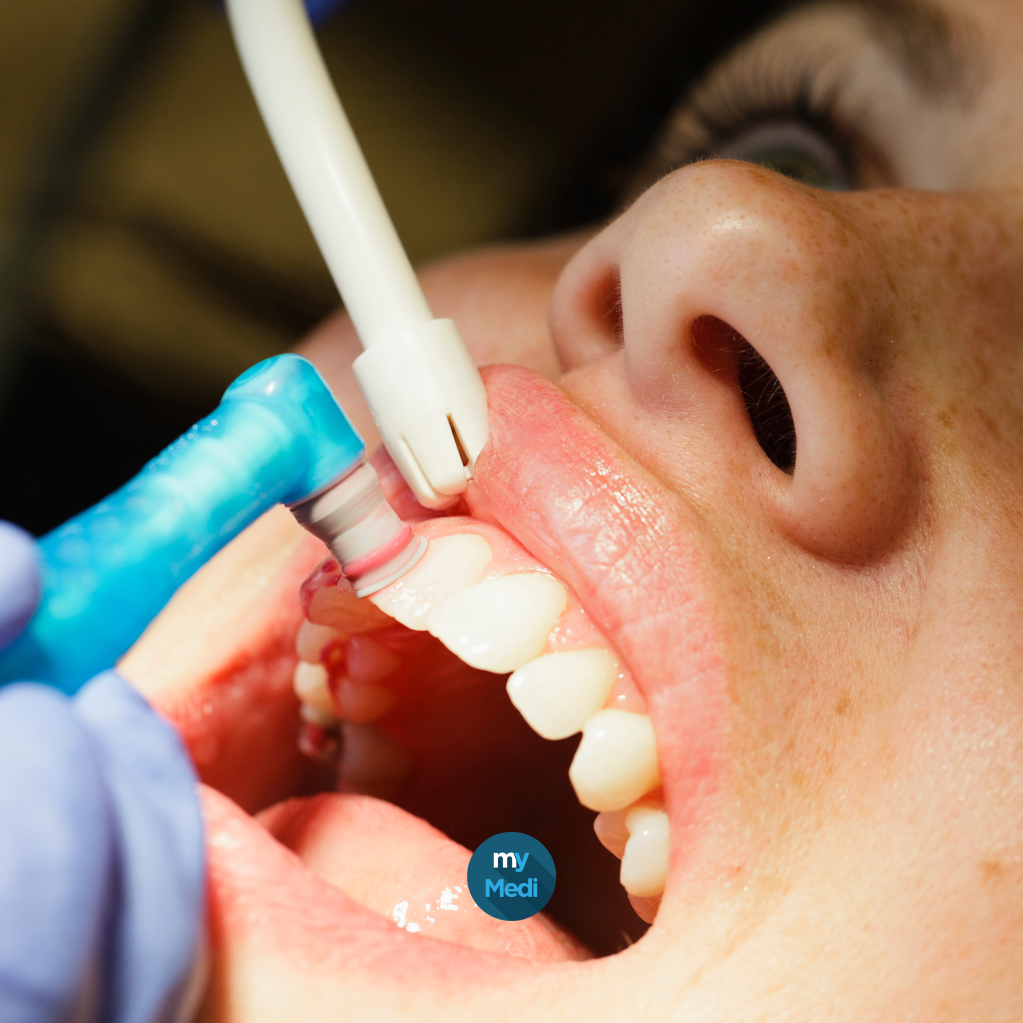 Disques et polisseurs dentaire