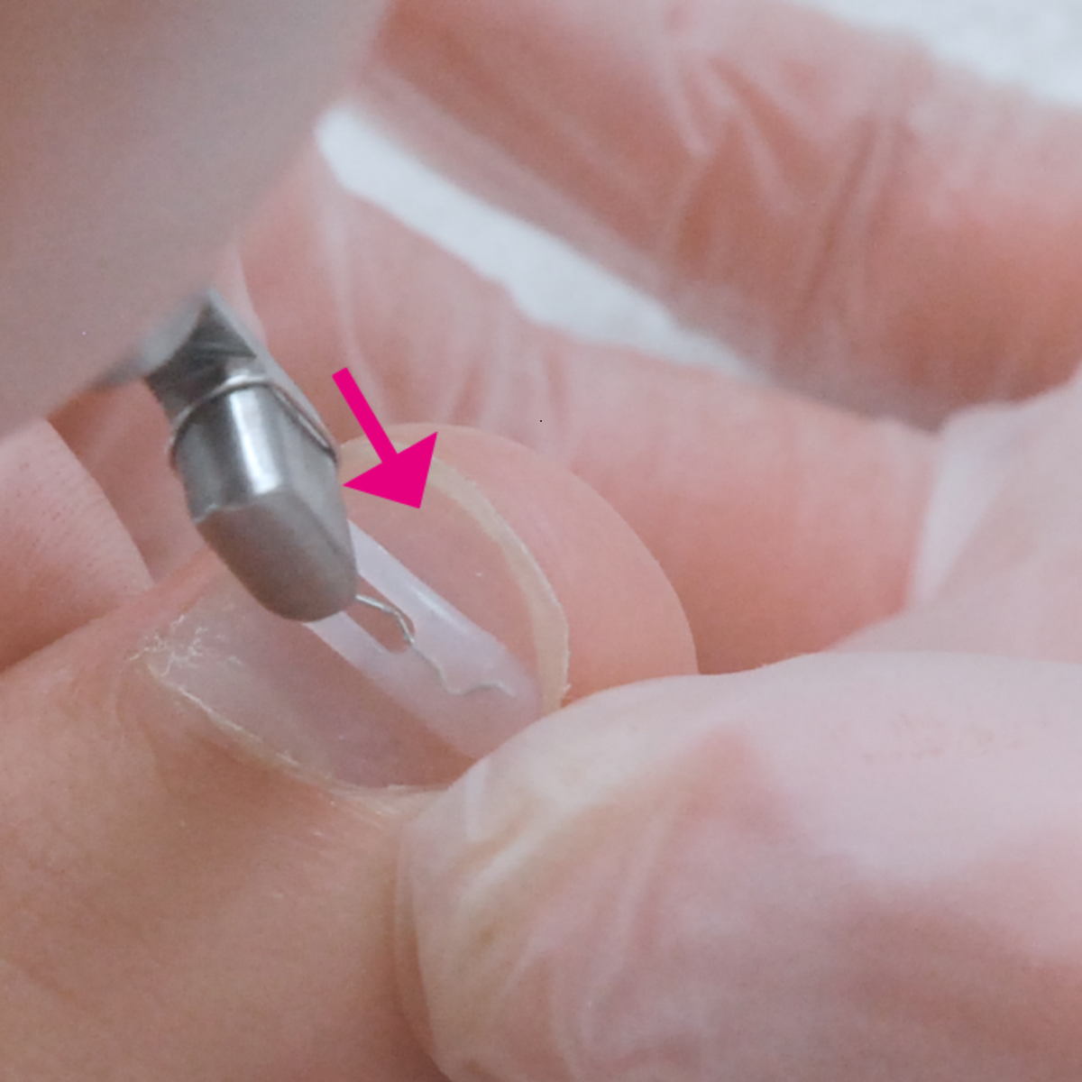 Kit complet d’orthonyxie pour ongles incarnés et déformés – Podofix - My Médical