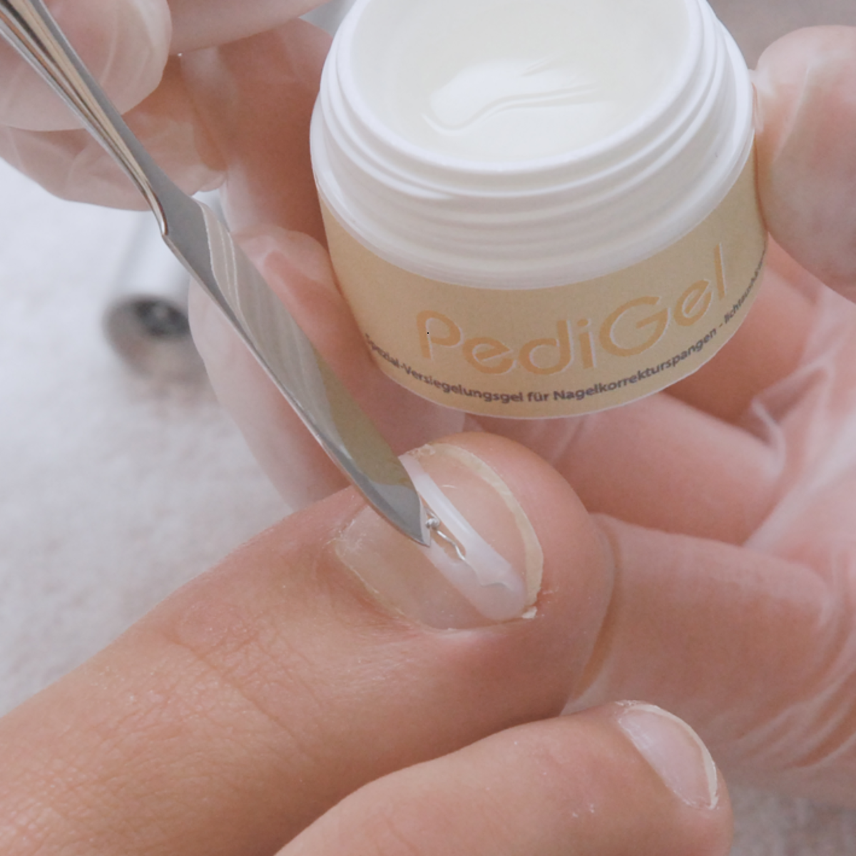 Languettes d’orthonyxie pour ongles incarnés et déformés - Différentes tailles - Podofix - My Médical