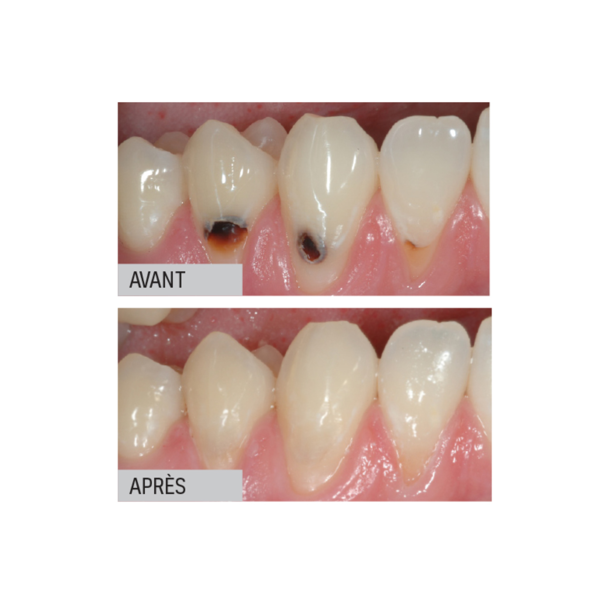 Riva Light Cure - Verre ionomère - 50 capsules - plusieurs teintes - SDI