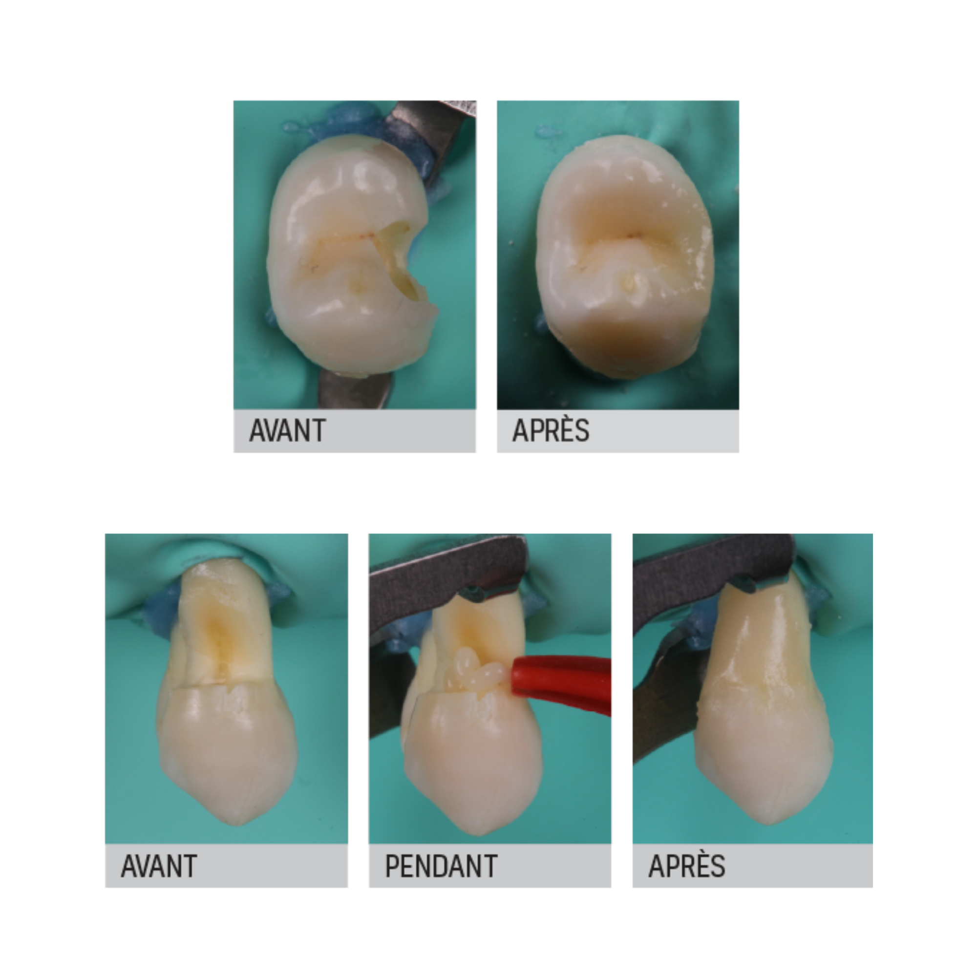 Riva Light Cure - Verre ionomère - 50 capsules - plusieurs teintes - SDI